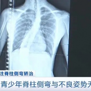 调整姿势就能“治好”孩子脊柱侧弯？家长请注意这些误区→
